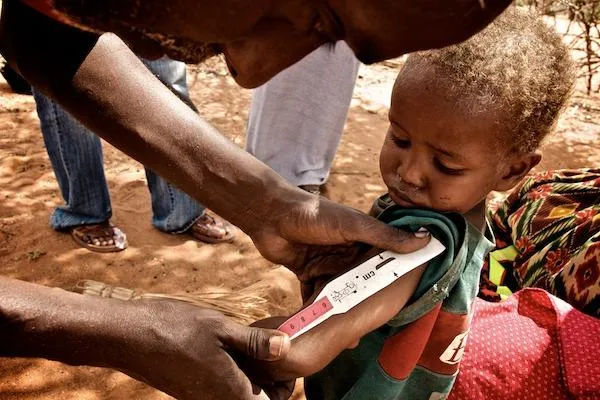 Photo: Colin Crowley, NEkenyaFB21|Young boy with lack of hair pigment due to protein deficiency during nutrition survey in Wajir District, Flickr, CC by 2.0
